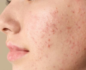 Prevents Acne
